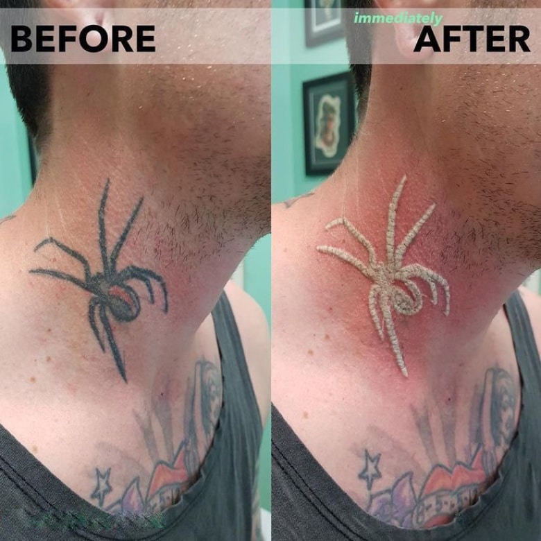 before and after tattoo removal