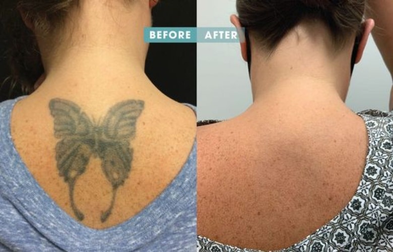 before and after tattoo removal